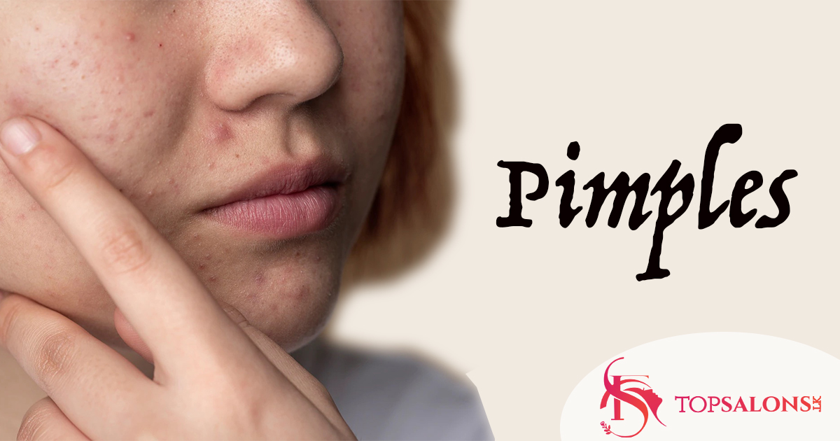 How to get rid of pimples